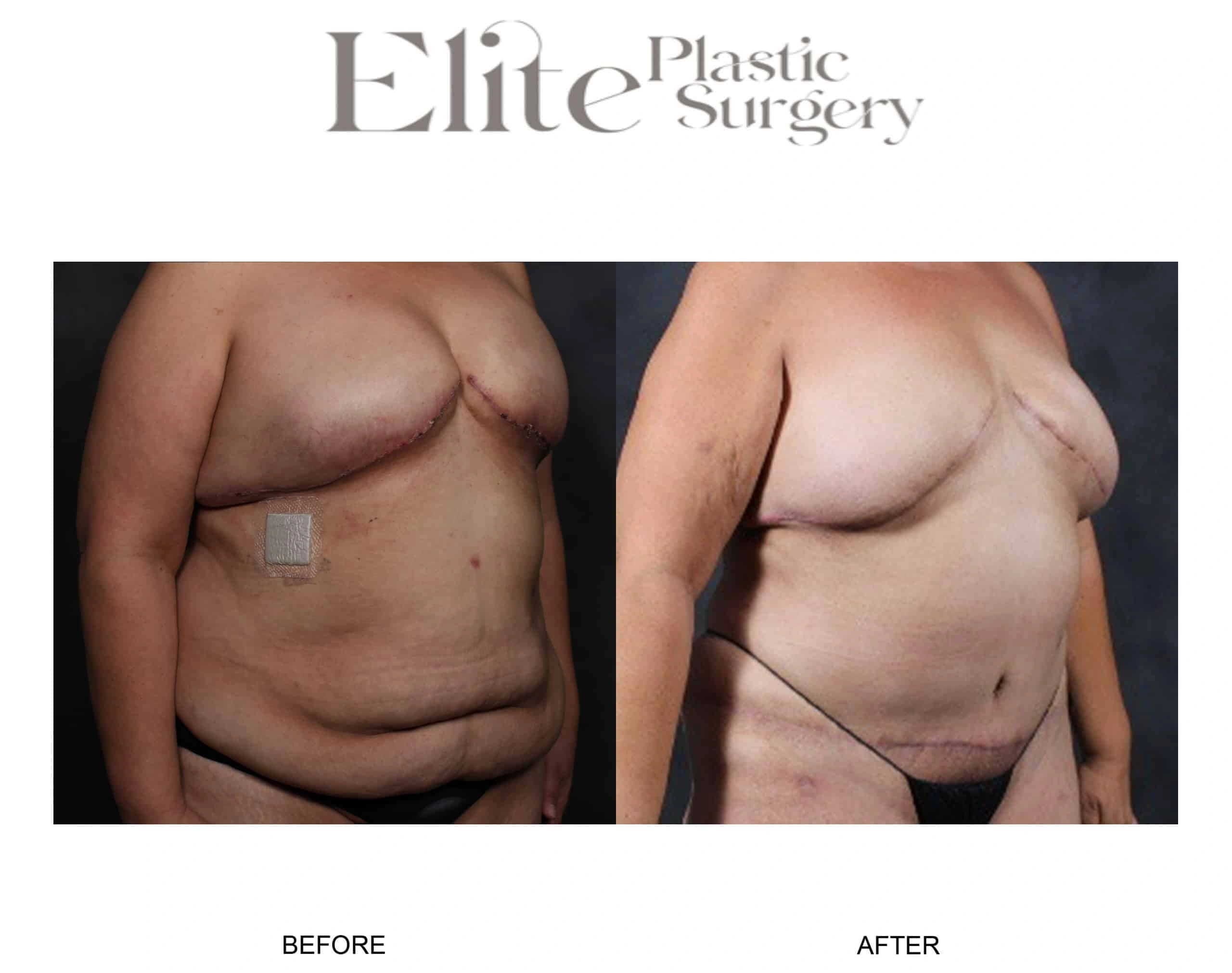 Real patient results before and after plastic surgery results in Arizona, performed by Dr. Torabi