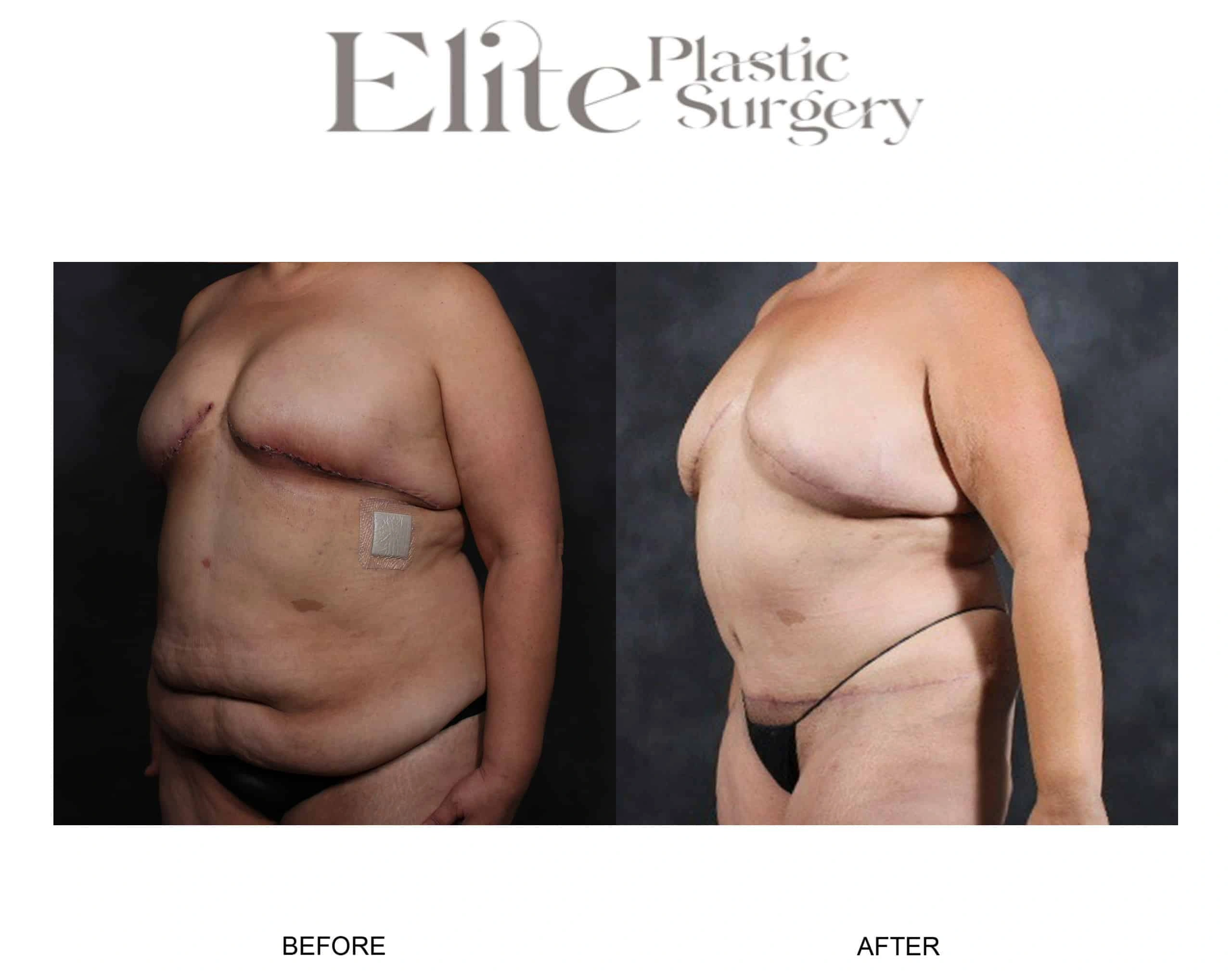 Real patient results before and after plastic surgery results in Arizona, performed by Dr. Torabi