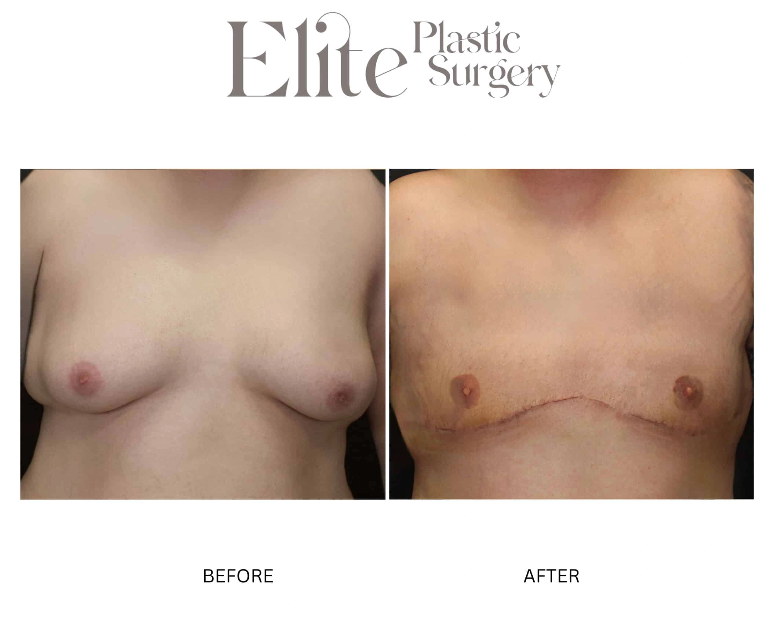 Real patient results before and after plastic surgery results in Arizona, performed by Dr. Torabi