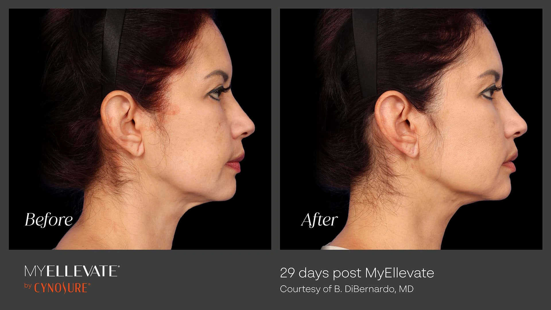 Real patient results before and after plastic surgery results in Arizona, performed by Dr. Torabi