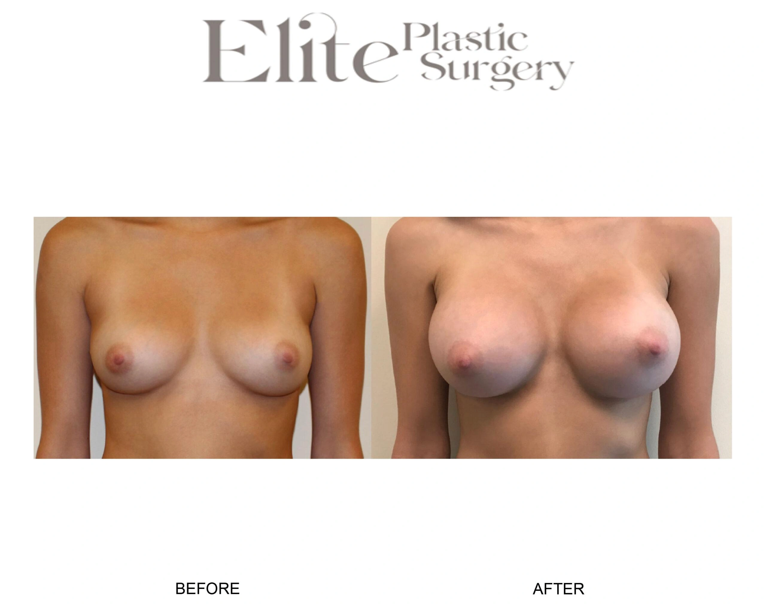 Real patient results before and after plastic surgery results in Arizona, performed by Dr. Torabi