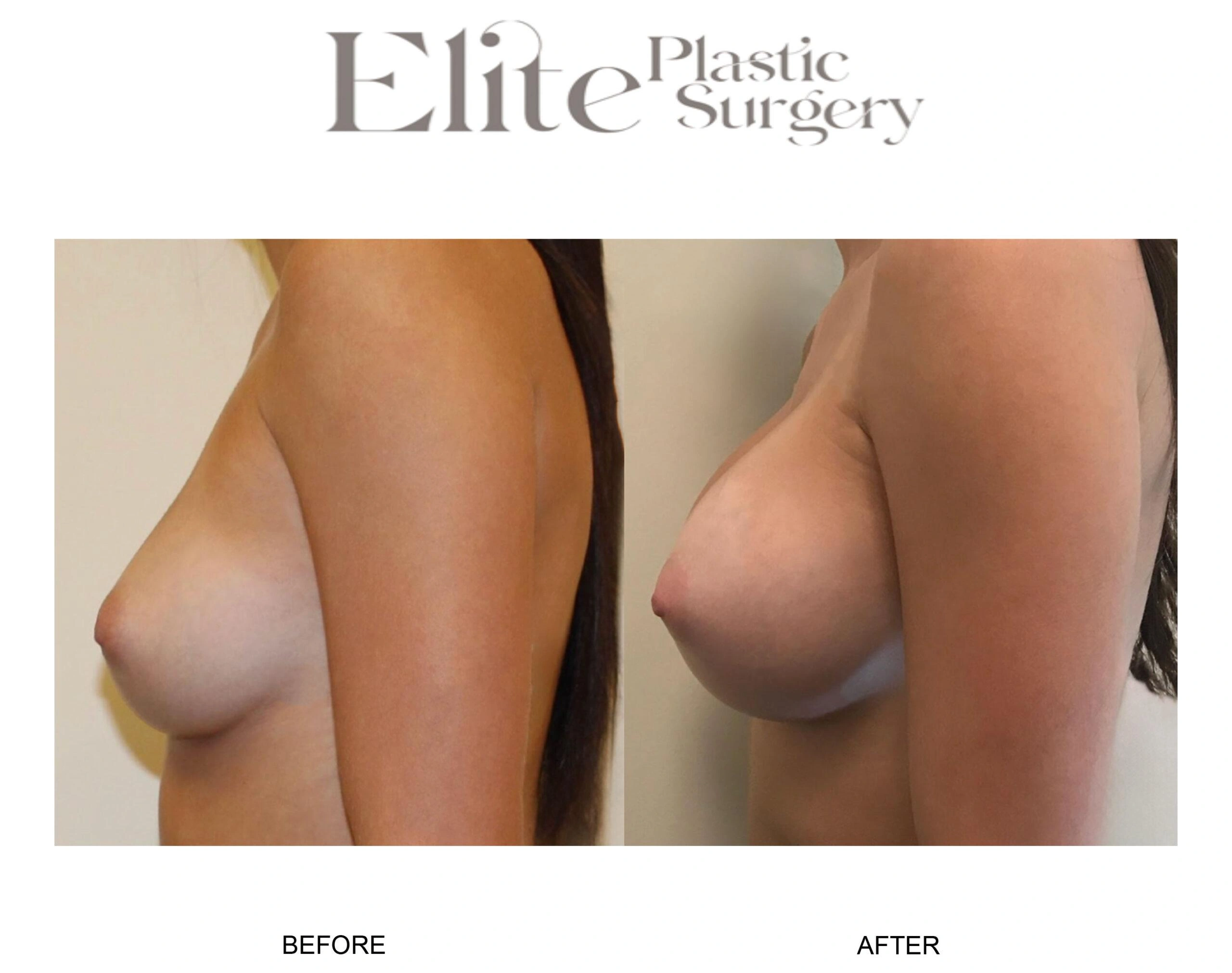 Real patient results before and after plastic surgery results in Arizona, performed by Dr. Torabi