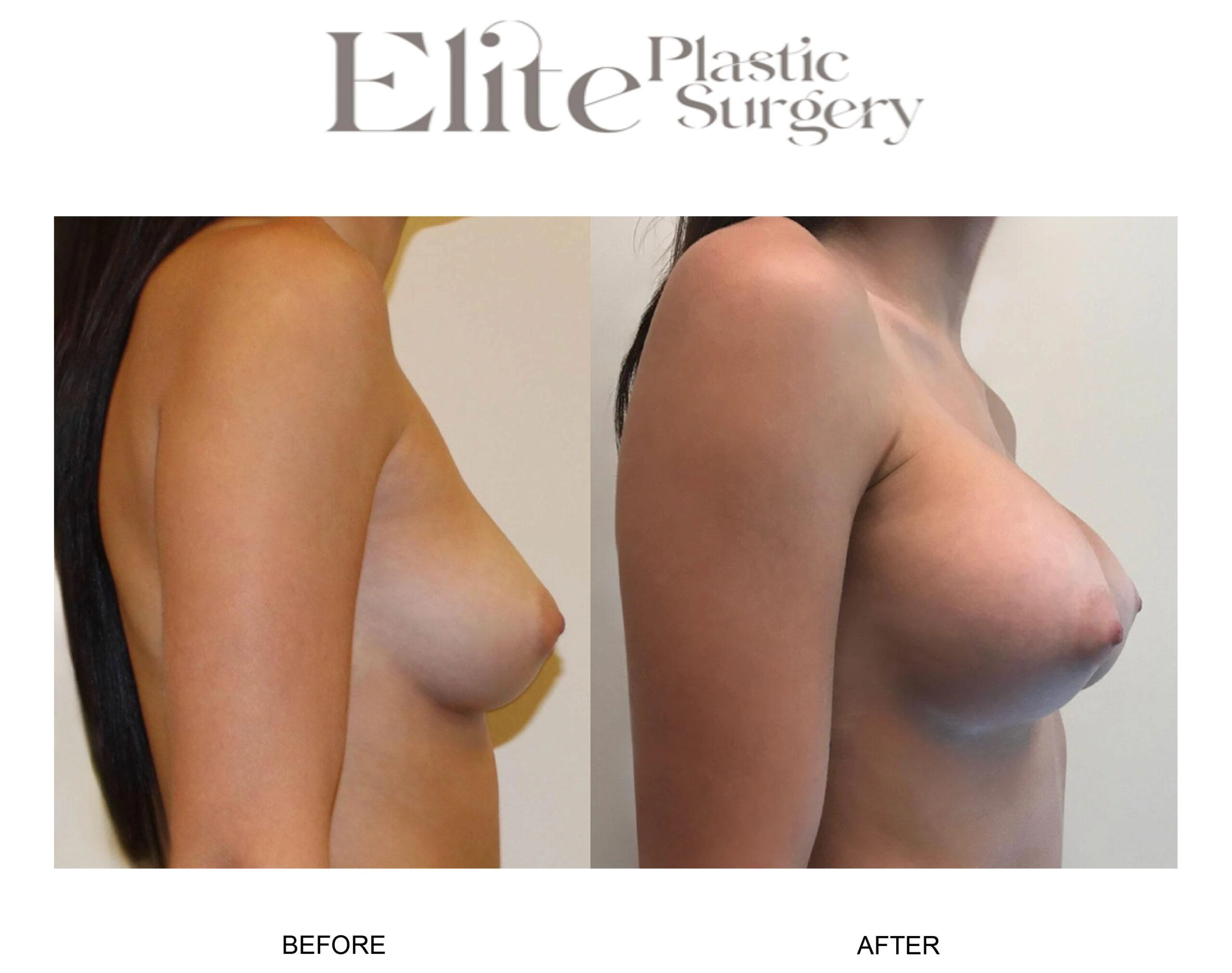 Real patient results before and after plastic surgery results in Arizona, performed by Dr. Torabi