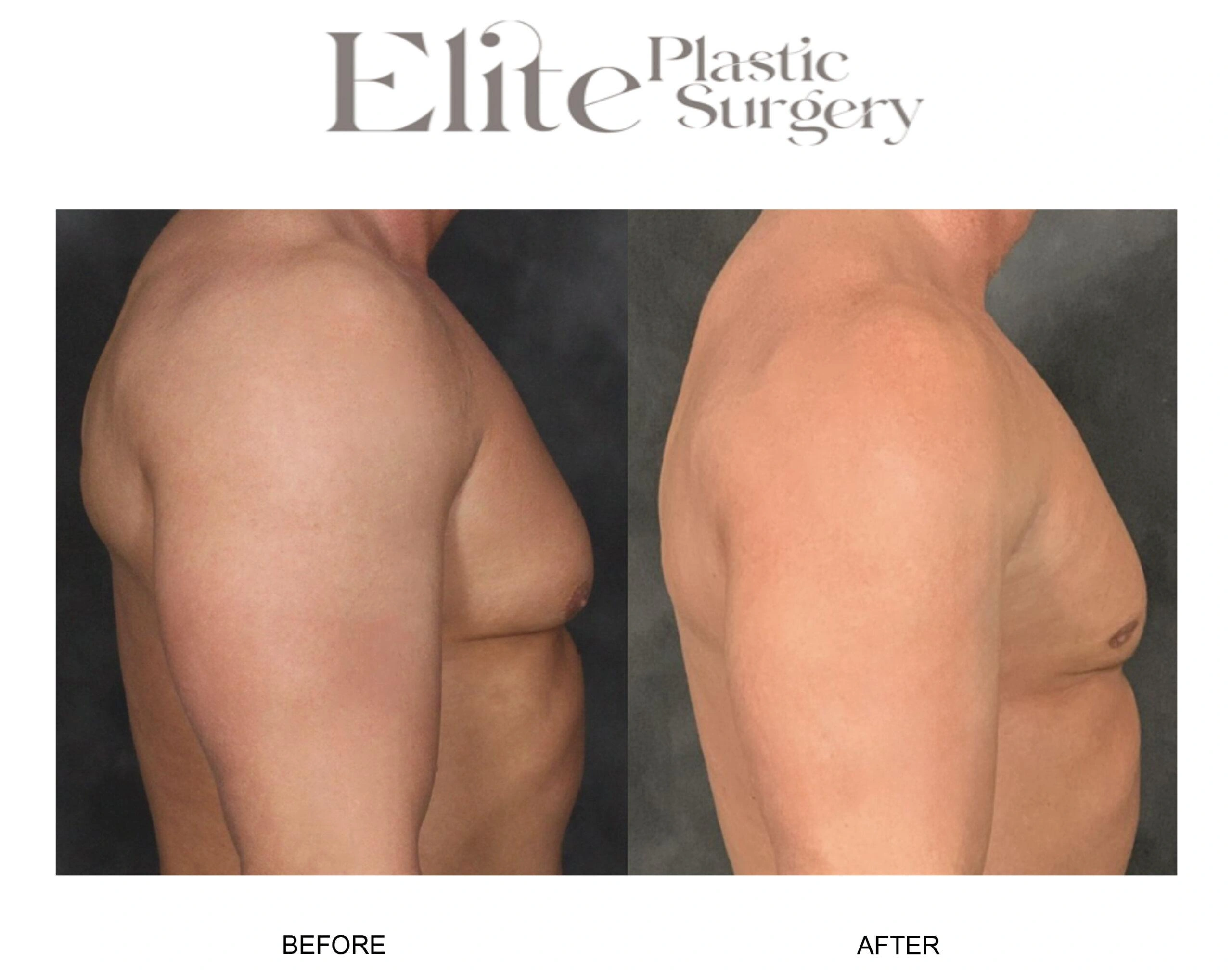 Real patient results before and after plastic surgery results in Arizona, performed by Dr. Torabi