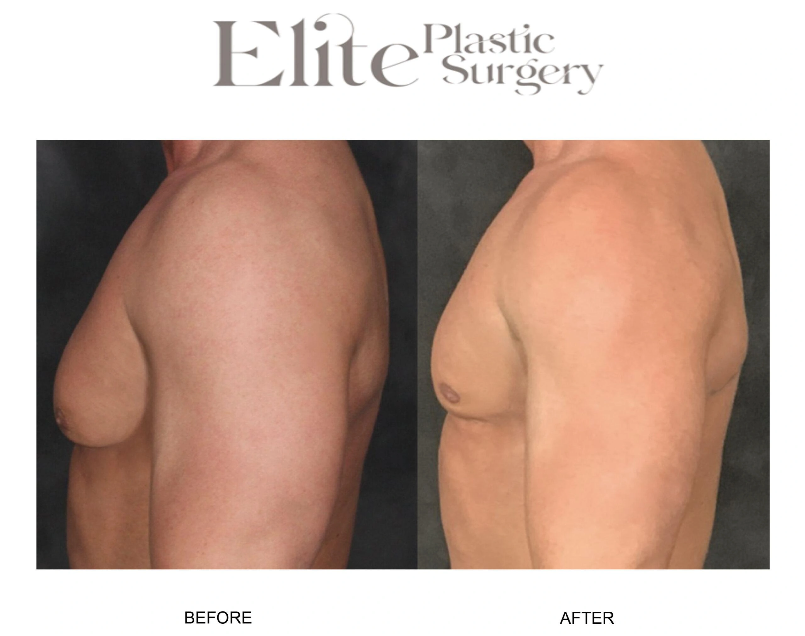 Real patient results before and after plastic surgery results in Arizona, performed by Dr. Torabi