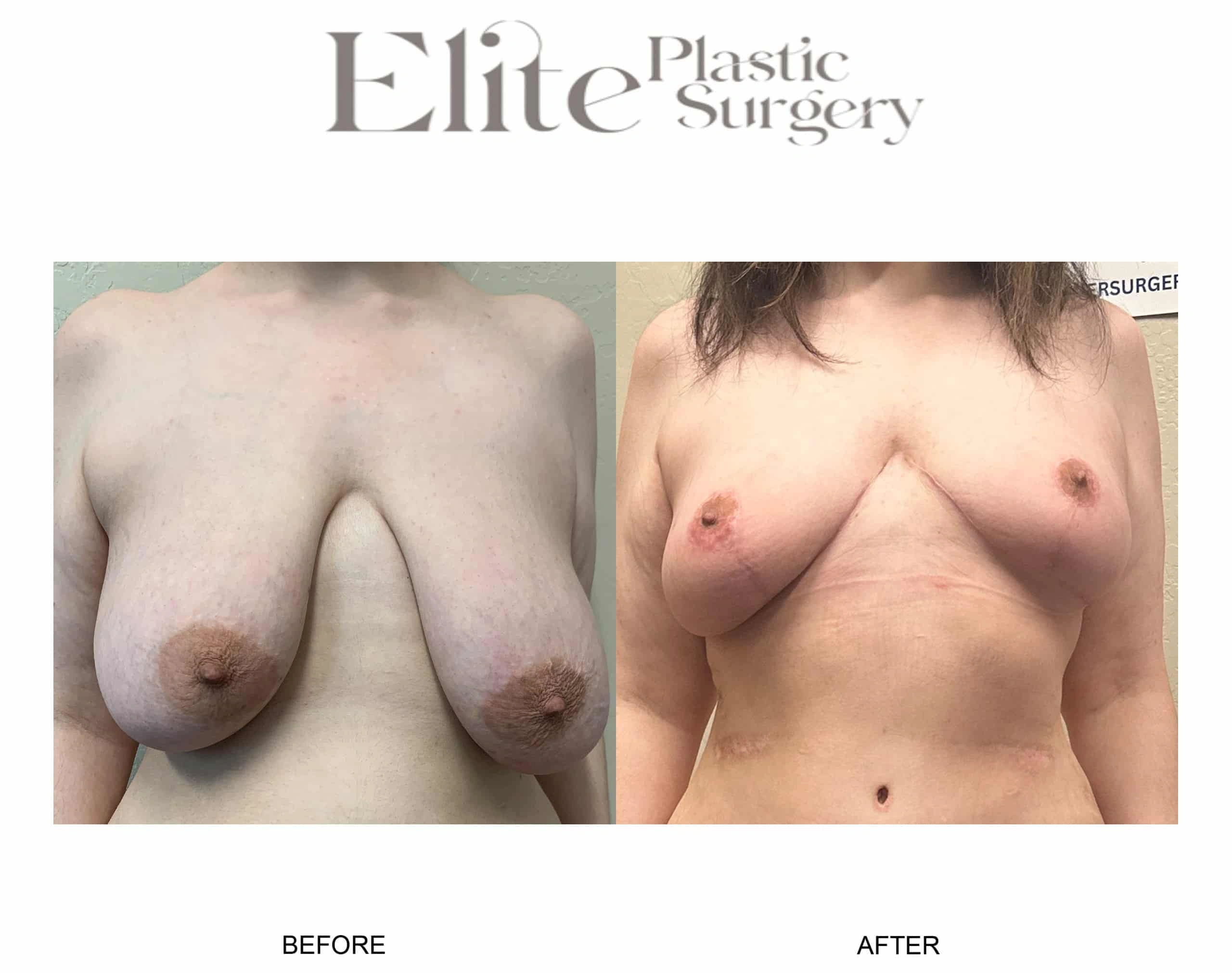 Real patient results before and after plastic surgery results in Arizona, performed by Dr. Torabi