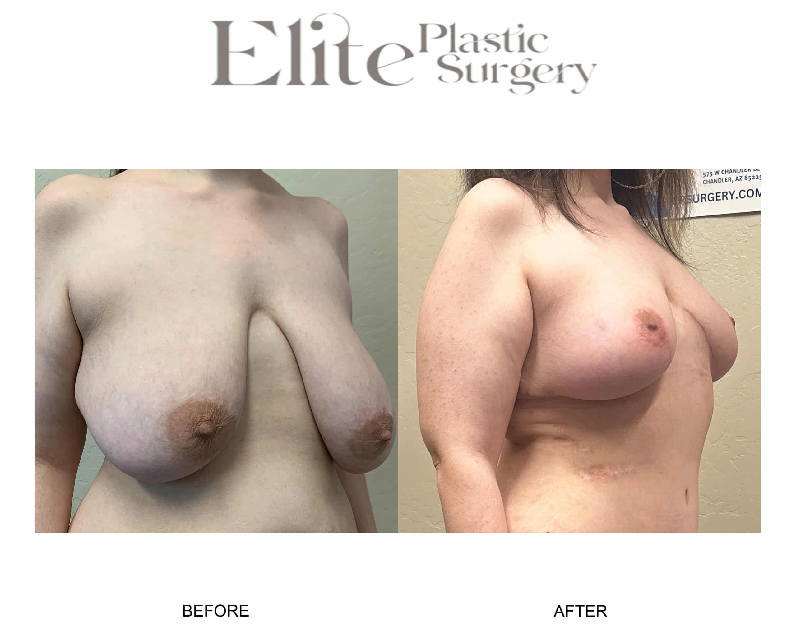 Real patient results before and after plastic surgery results in Arizona, performed by Dr. Torabi