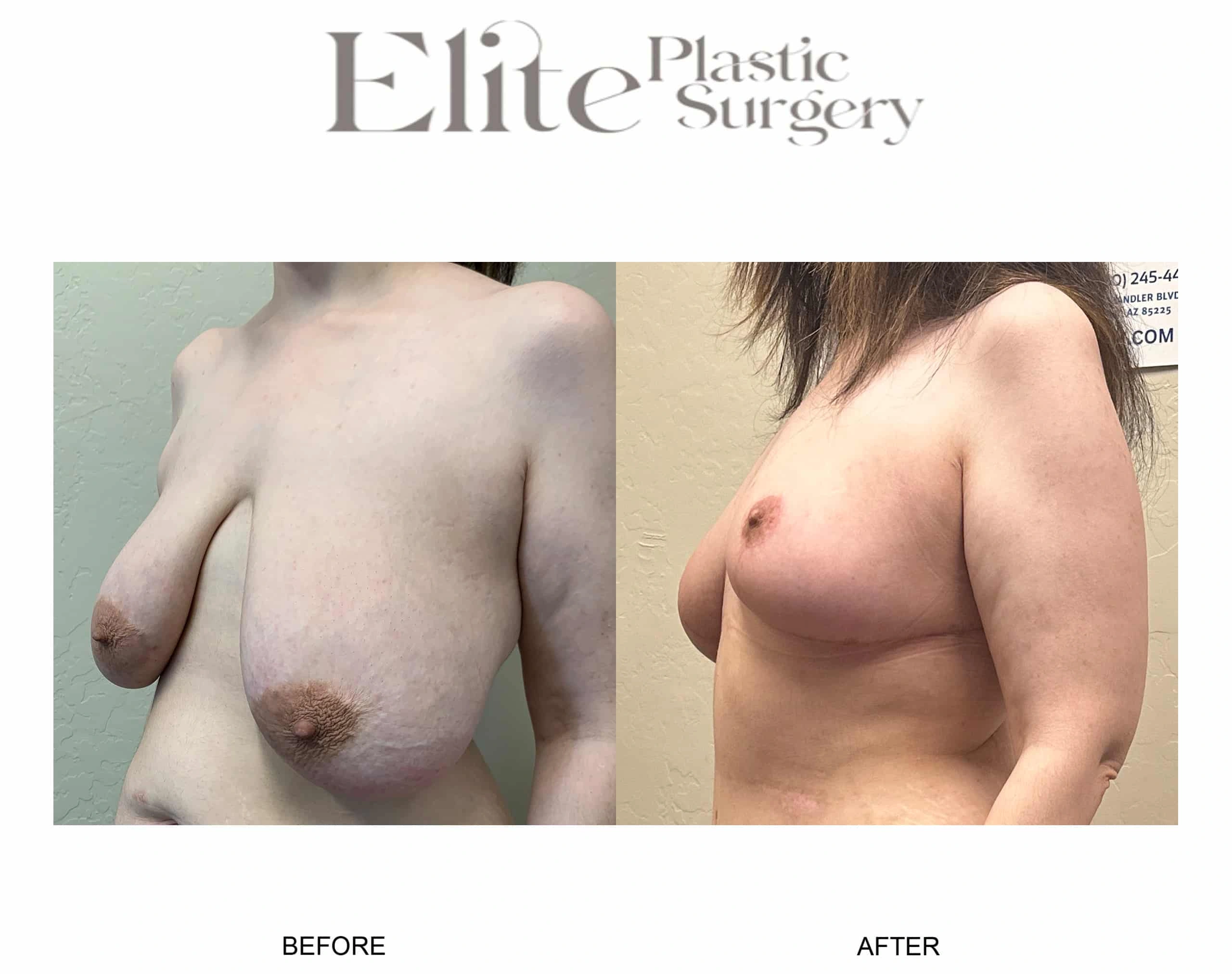 Real patient results before and after plastic surgery results in Arizona, performed by Dr. Torabi