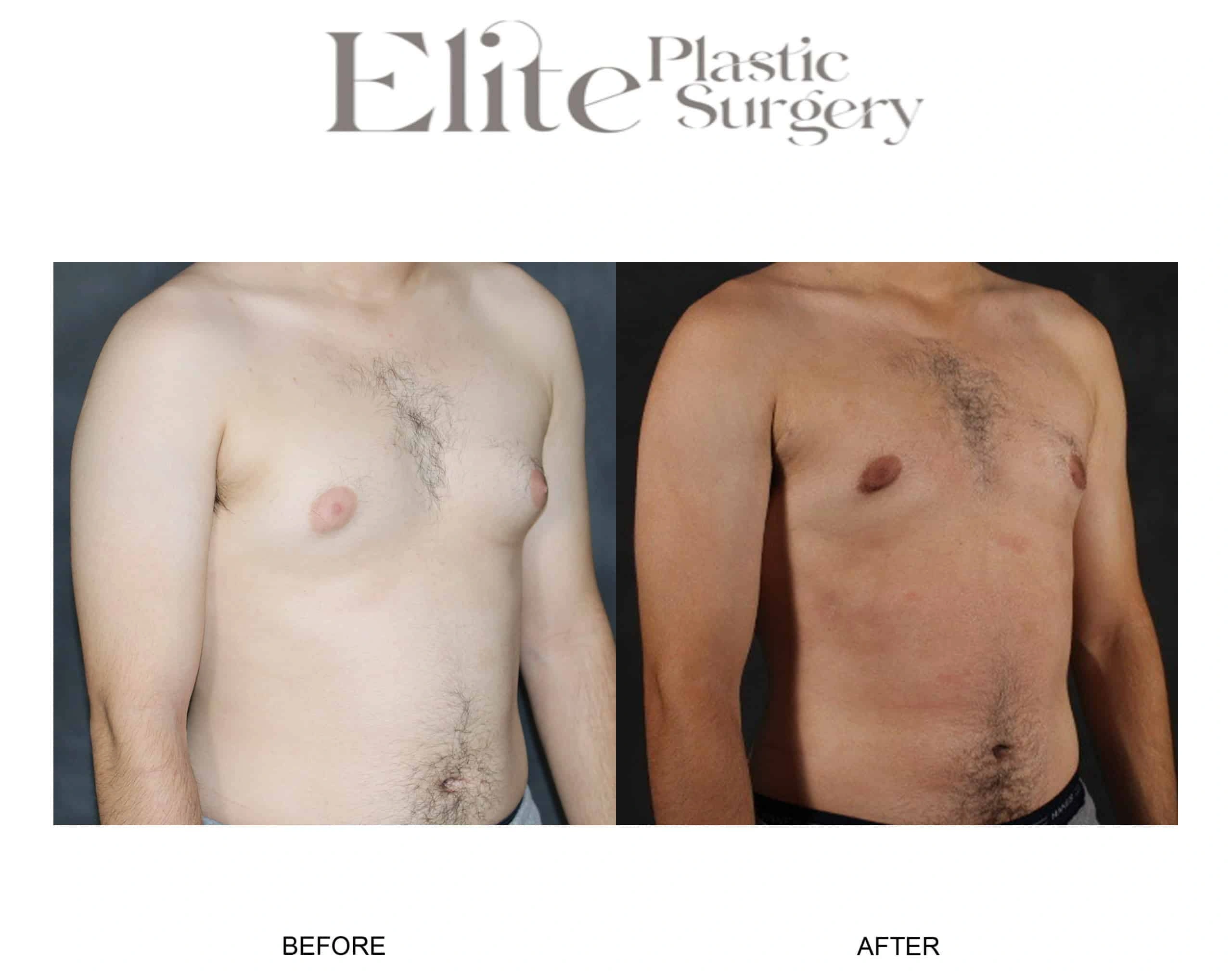 Real patient results before and after plastic surgery results in Arizona, performed by Dr. Torabi