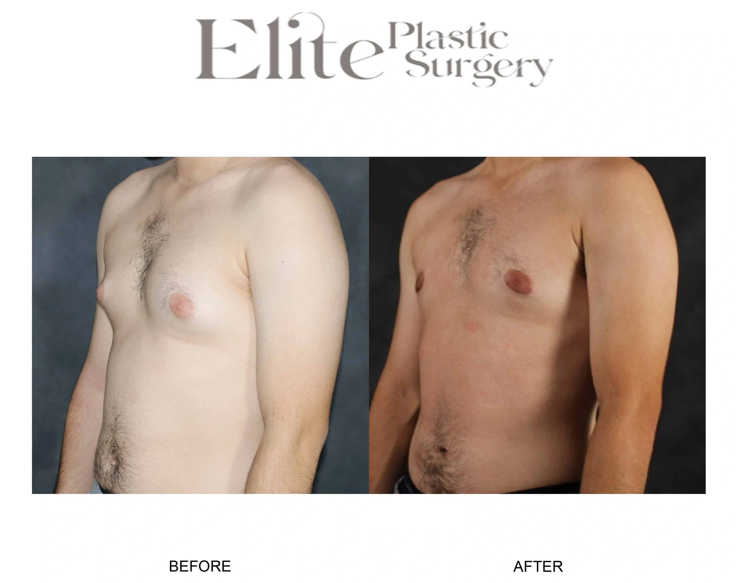 Real patient results before and after plastic surgery results in Arizona, performed by Dr. Torabi