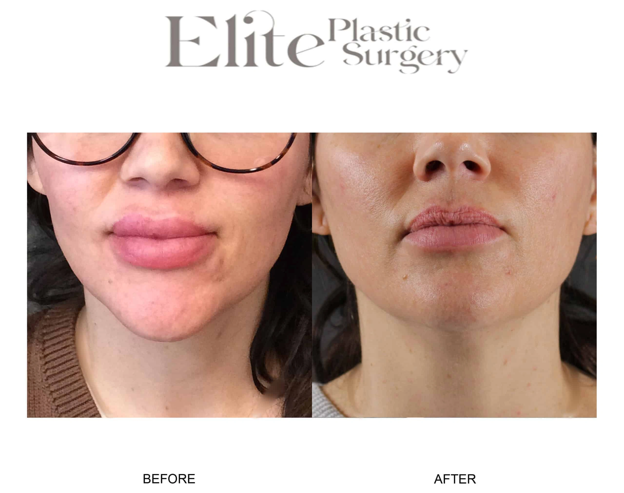 Real patient results before and after plastic surgery results in Arizona, performed by Dr. Torabi