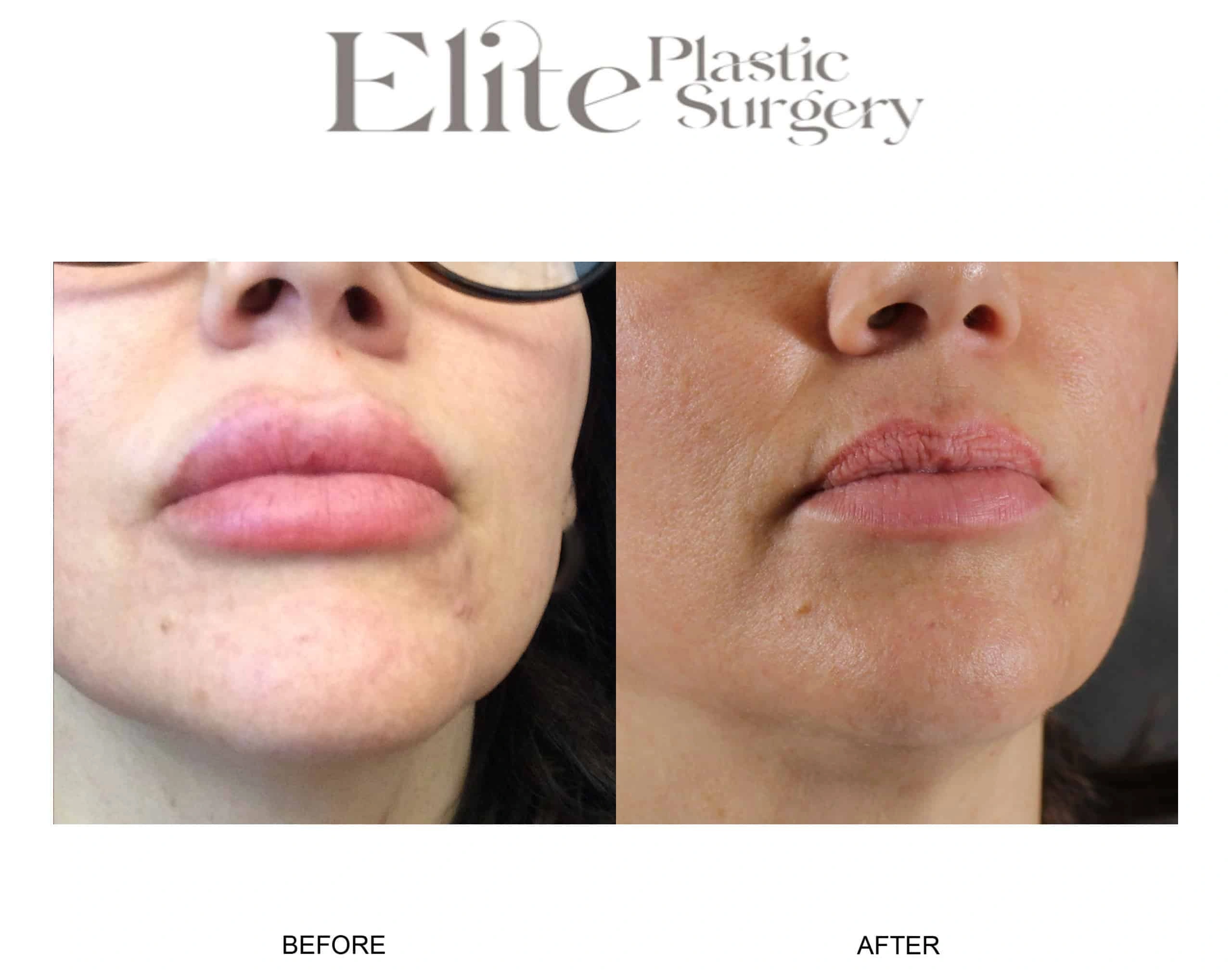 Real patient results before and after plastic surgery results in Arizona, performed by Dr. Torabi