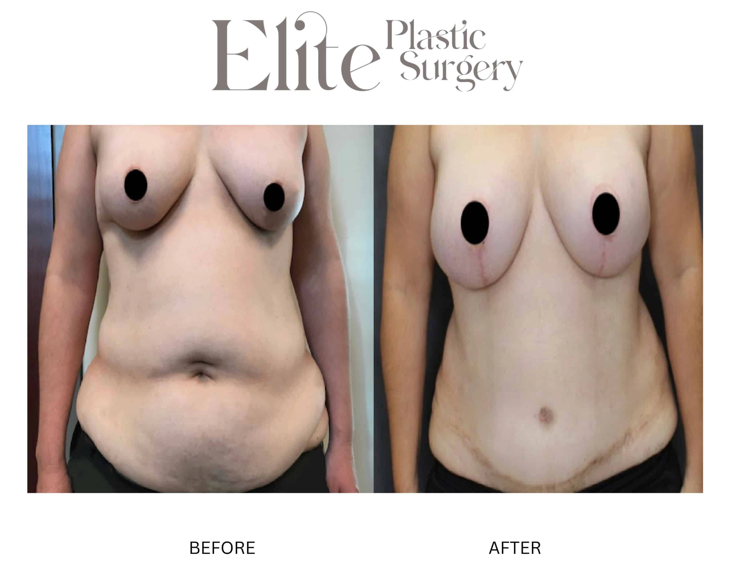 Real patient results before and after plastic surgery results in Arizona, performed by Dr. Torabi