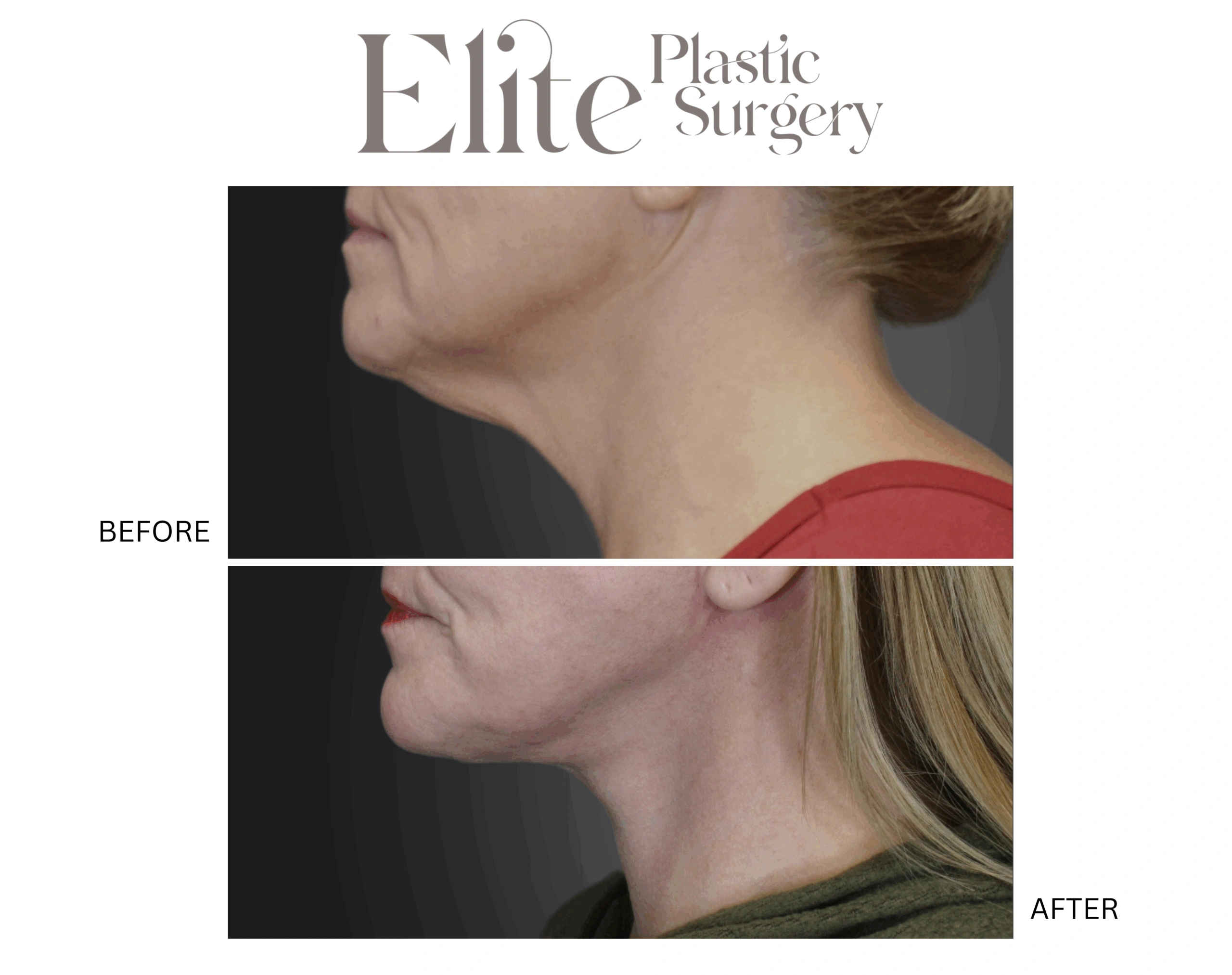 Real patient results before and after plastic surgery results in Arizona, performed by Dr. Torabi