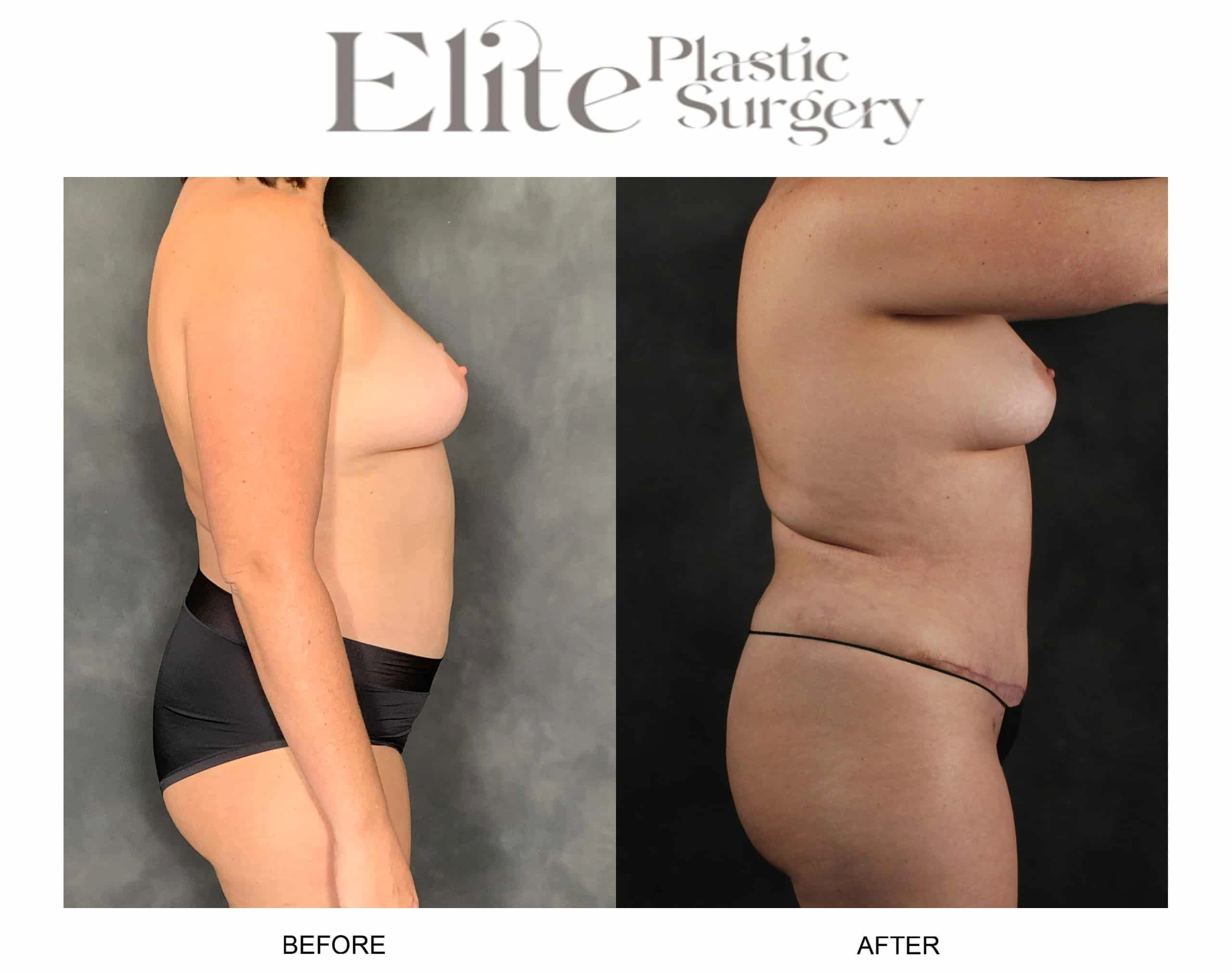 Real patient results before and after plastic surgery results in Arizona, performed by Dr. Torabi