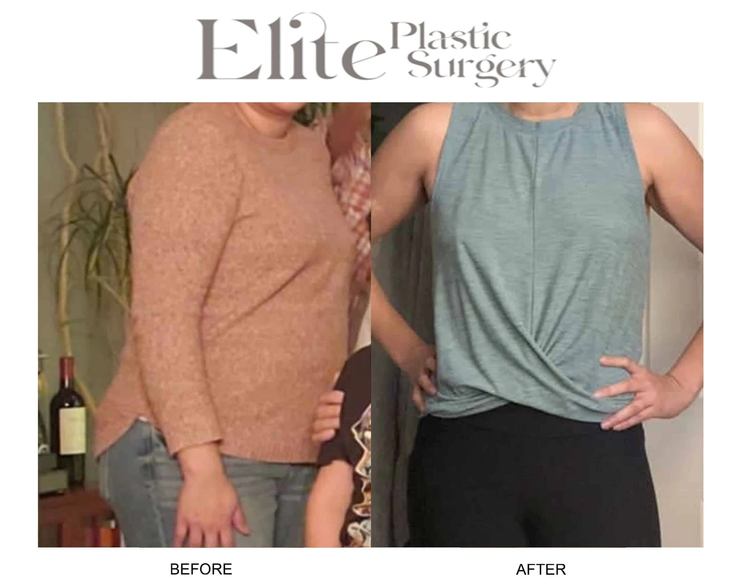 Real patient results before and after plastic surgery results in Arizona, performed by Dr. Torabi