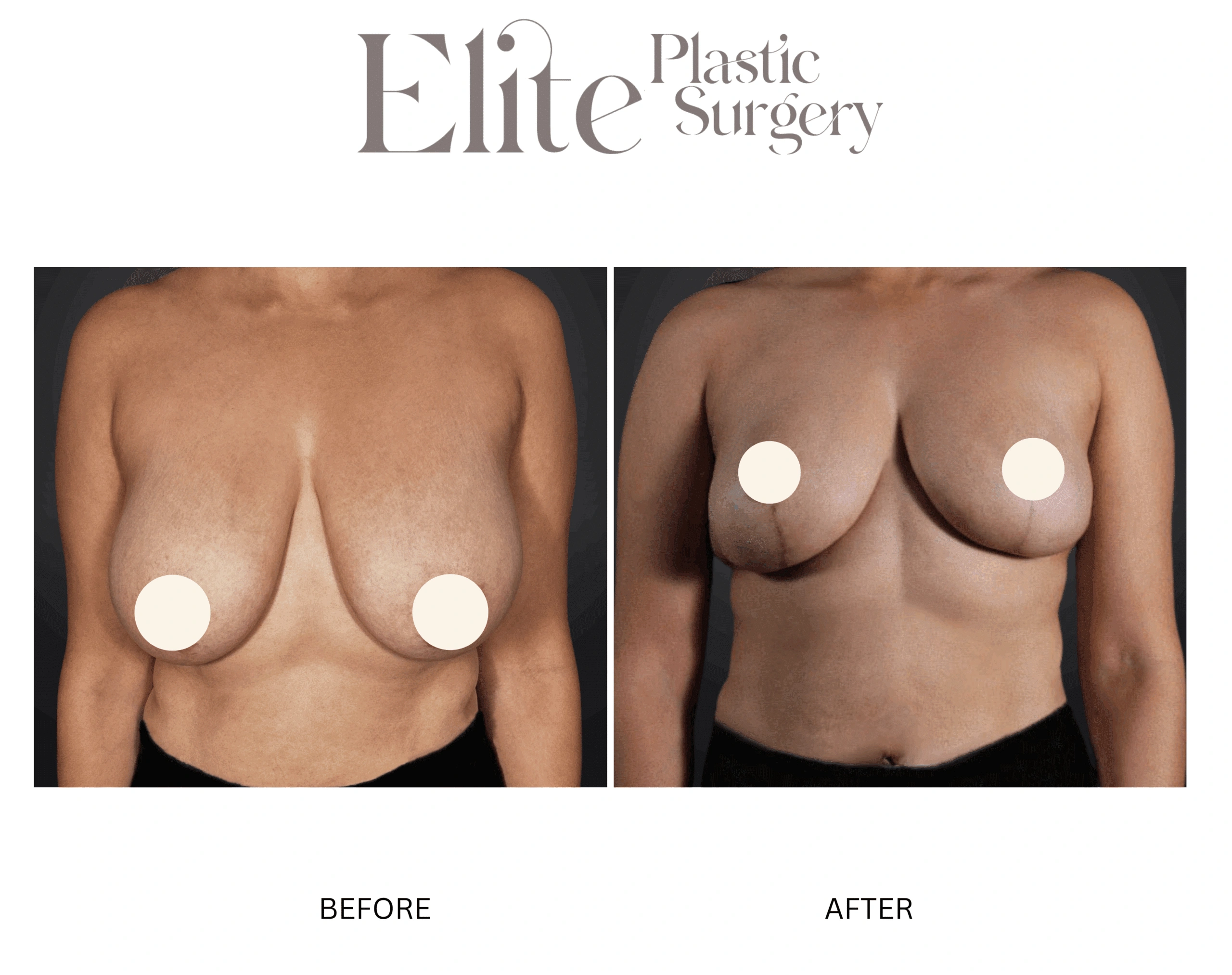 Real patient results before and after plastic surgery results in Arizona, performed by Dr. Torabi