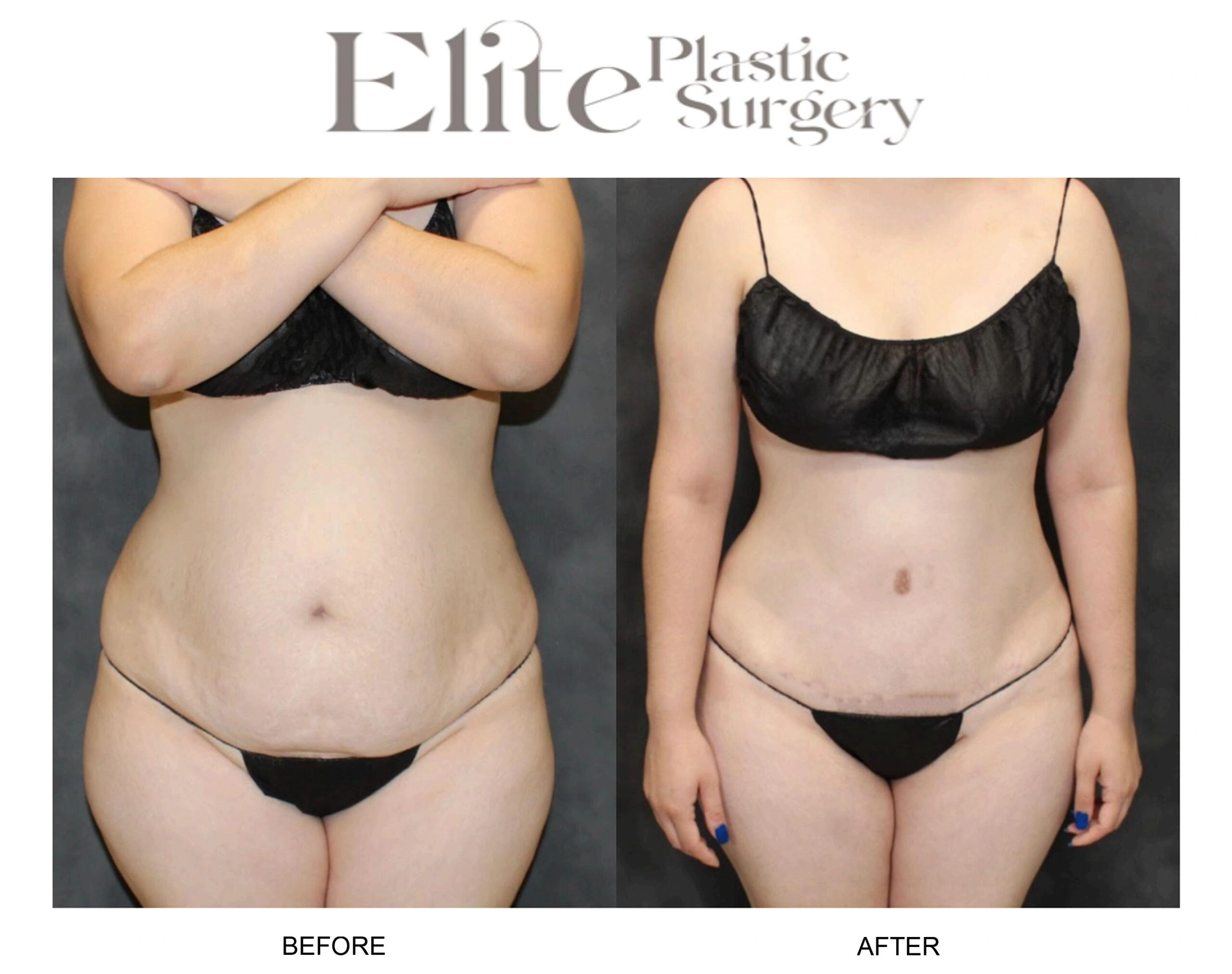 Real patient results before and after plastic surgery results in Arizona, performed by Dr. Torabi