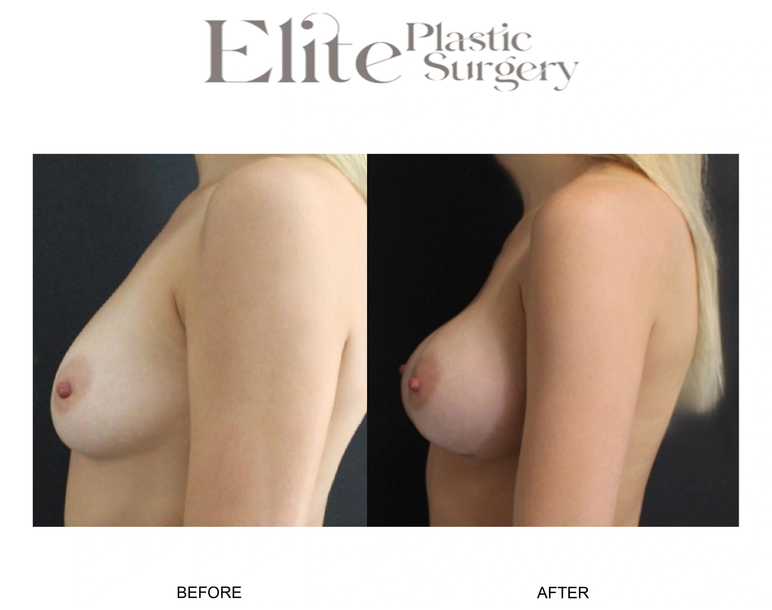 Real patient results before and after plastic surgery results in Arizona, performed by Dr. Torabi