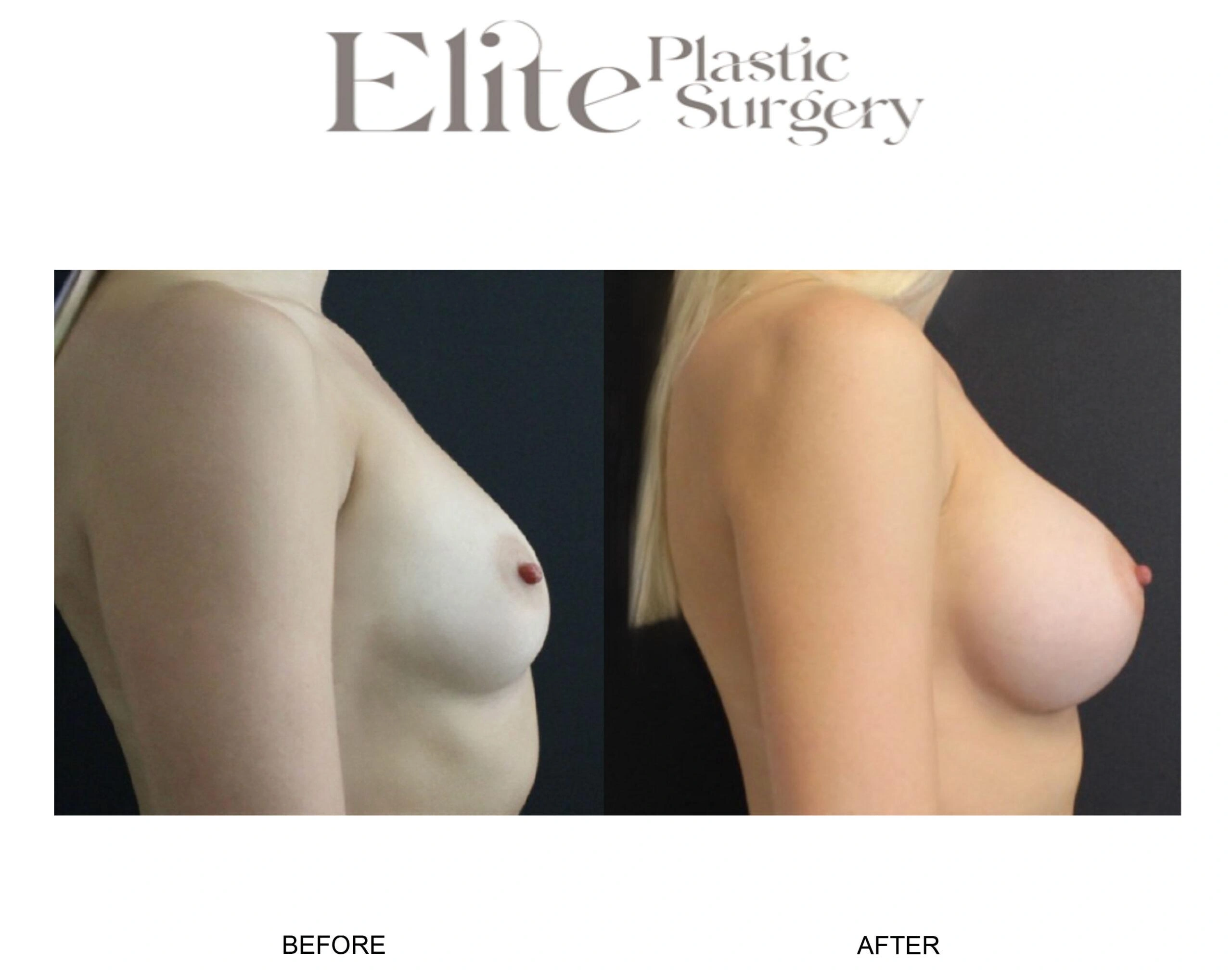 Real patient results before and after plastic surgery results in Arizona, performed by Dr. Torabi