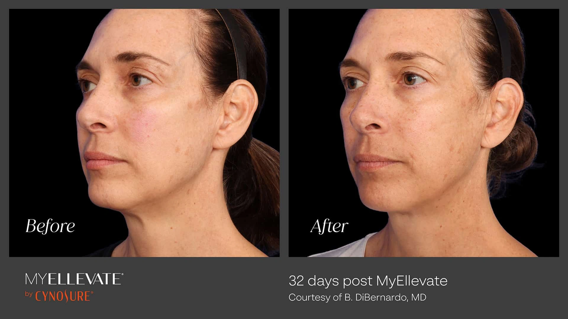 Real patient results before and after plastic surgery results in Arizona, performed by Dr. Torabi