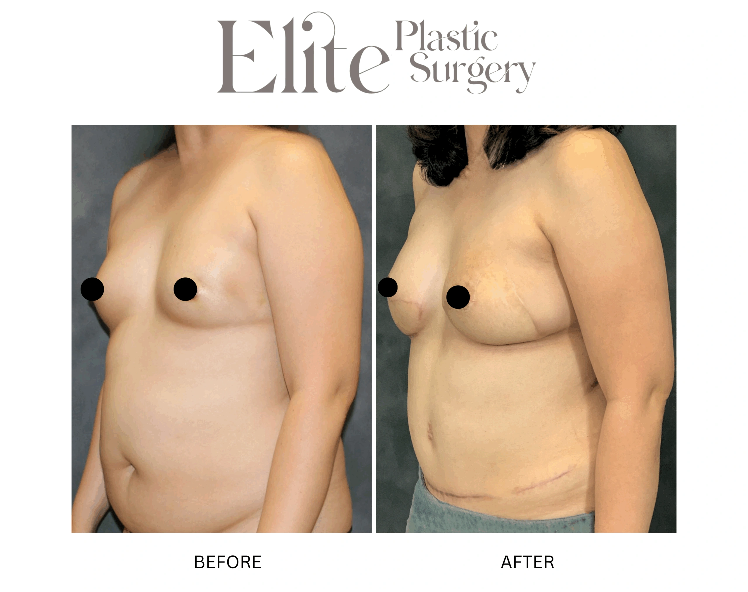 Real patient results before and after plastic surgery results in Arizona, performed by Dr. Torabi